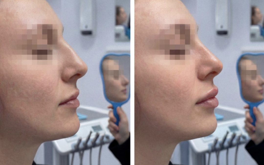 Filler Labbra e Viso