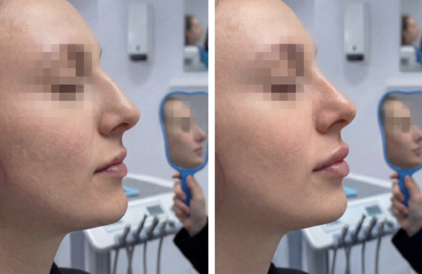 medicina-estetica-viso-filler-labbra-naso-rinofiller-stomadent-trapani-dentista