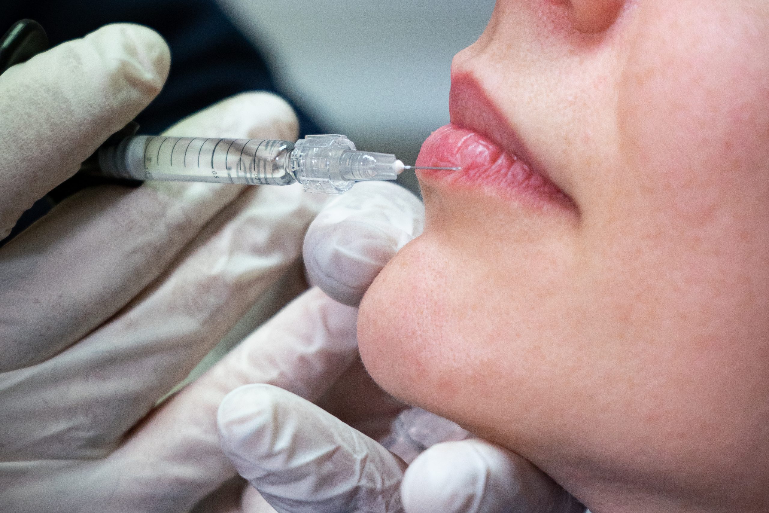 Filler Labbra-stomadent-trapani