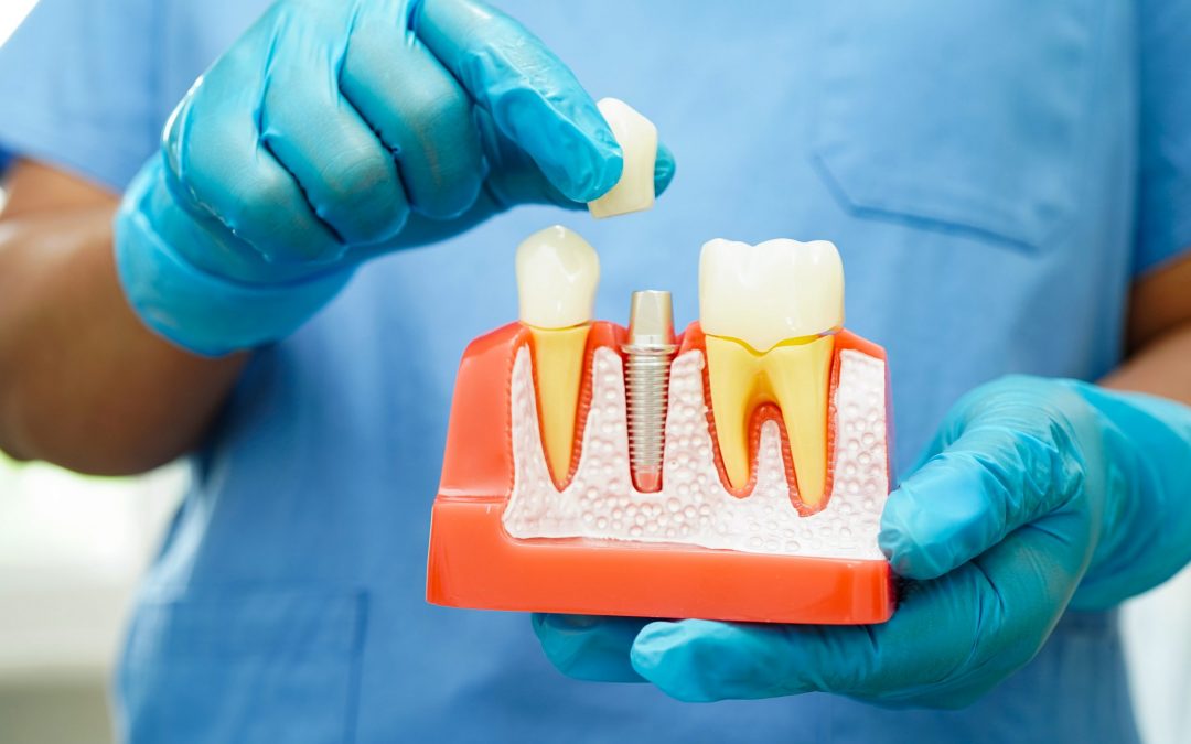 Implantologia Dentale Avanzata