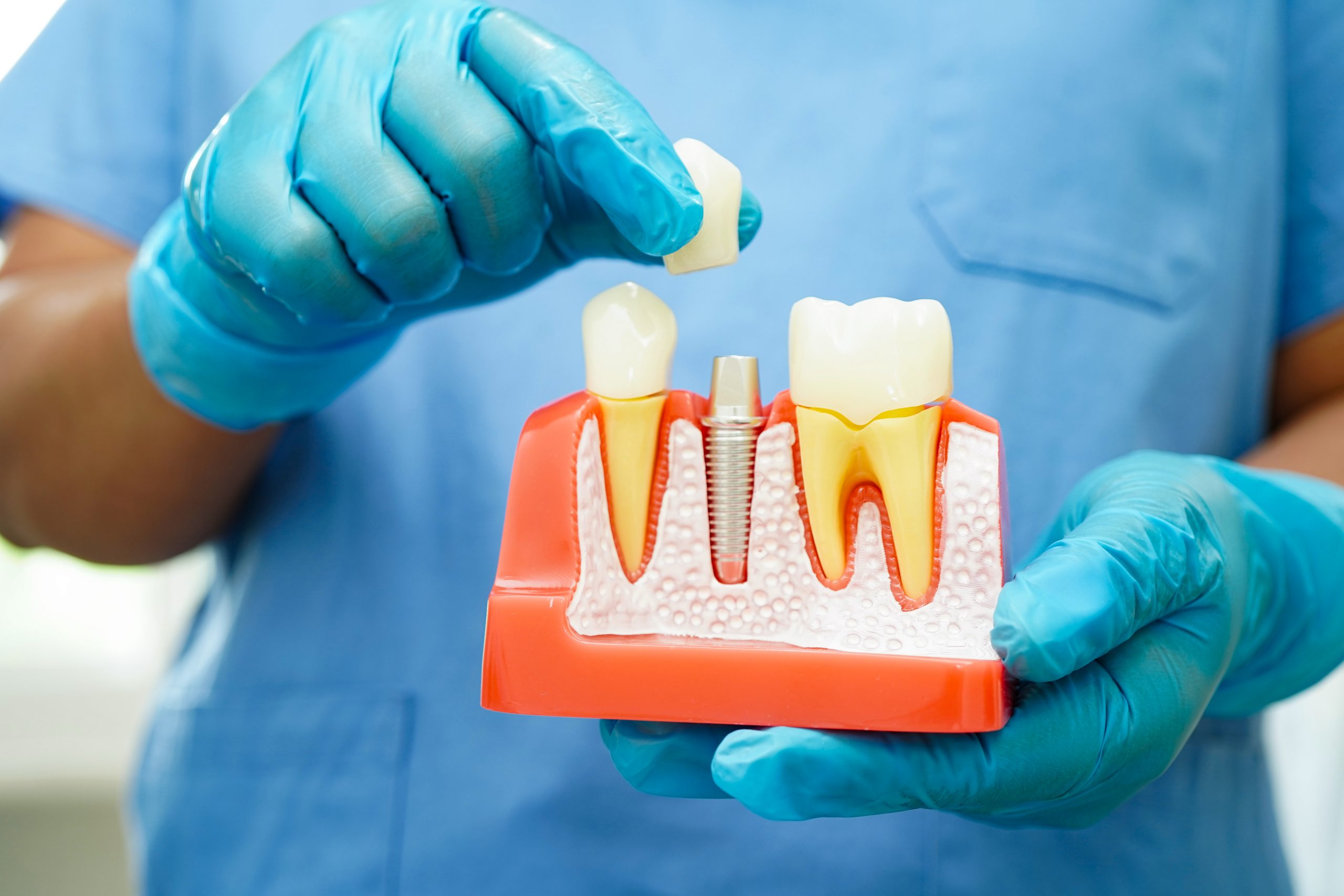 Implantologia dentale avanzata-stomadent-trapani