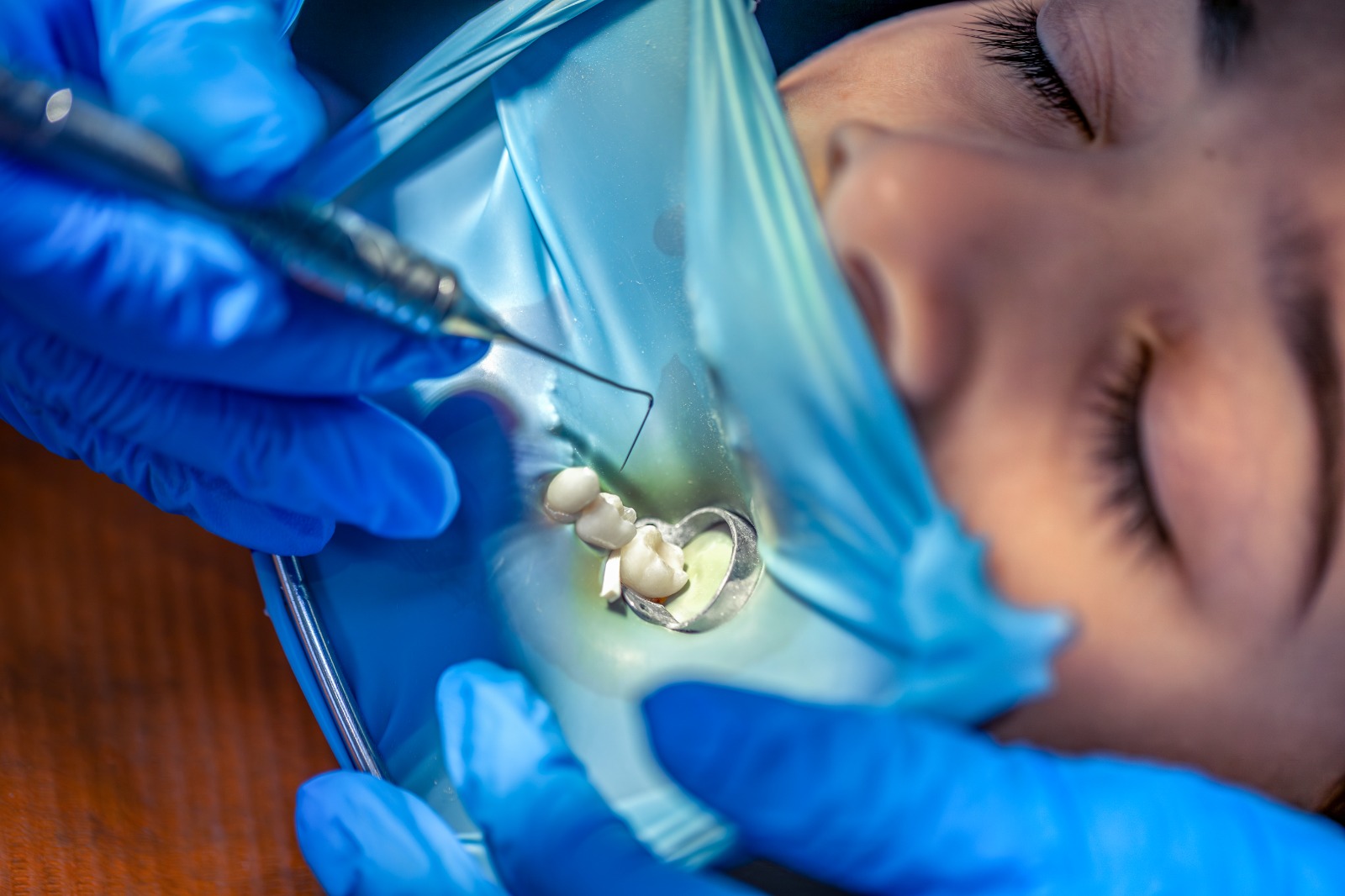 conservativa ed endodonzia-stomadent-trapani-dentista
