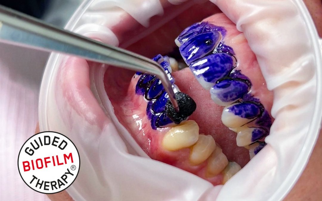 Prevenzione Dentale Avanzata